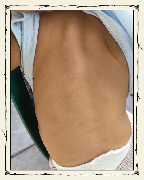 儿童对牛奶过敏会有哪些典型症状？家长该如何早期识别与应对？-第1张图片-郑州医学网