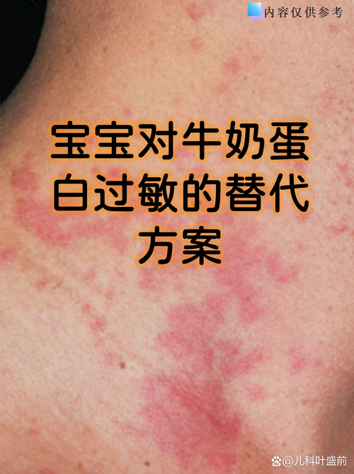 儿童对牛奶过敏会有哪些典型症状？家长该如何早期识别与应对？-第3张图片-郑州医学网