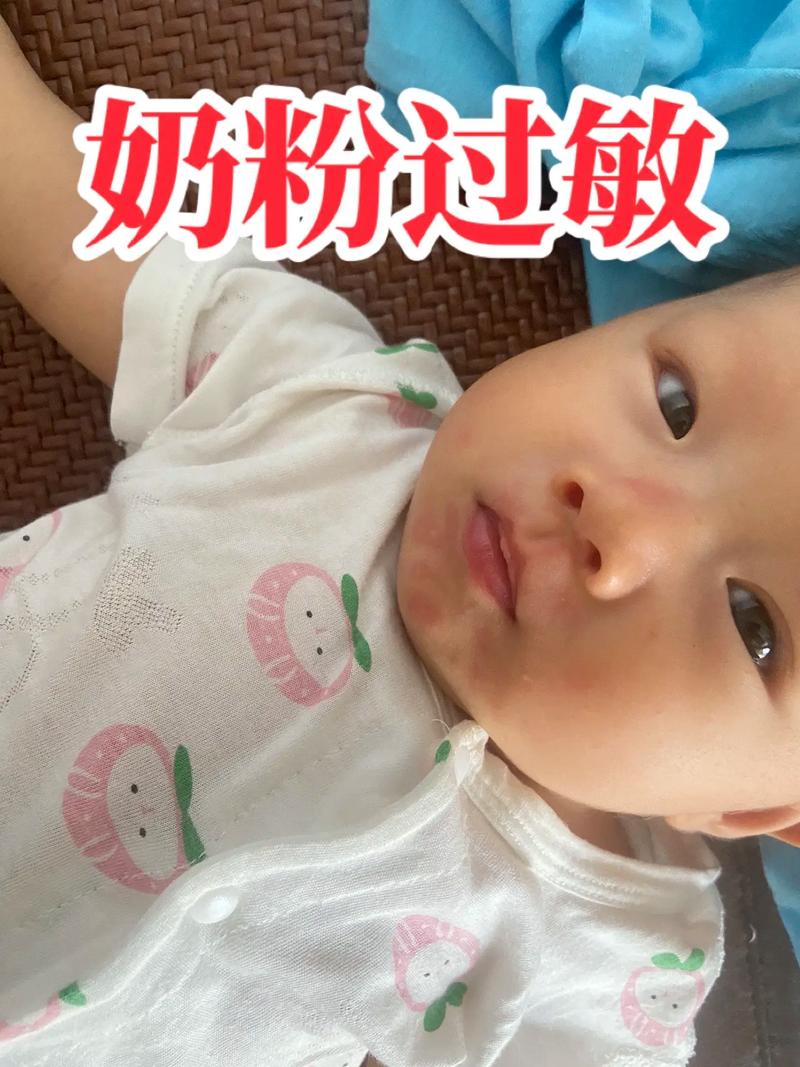 儿童对牛奶过敏会有哪些典型症状？家长该如何早期识别与应对？-第2张图片-郑州医学网