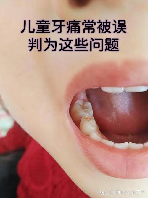 儿童牙痛真的会引起发烧吗？背后可能隐藏哪些健康信号？-第2张图片-郑州医学网