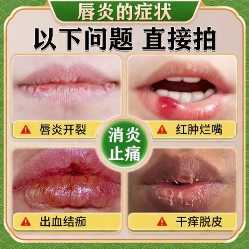 儿童嘴唇干裂用什么药？安全有效的儿童护唇药膏怎么选？-第3张图片-郑州医学网
