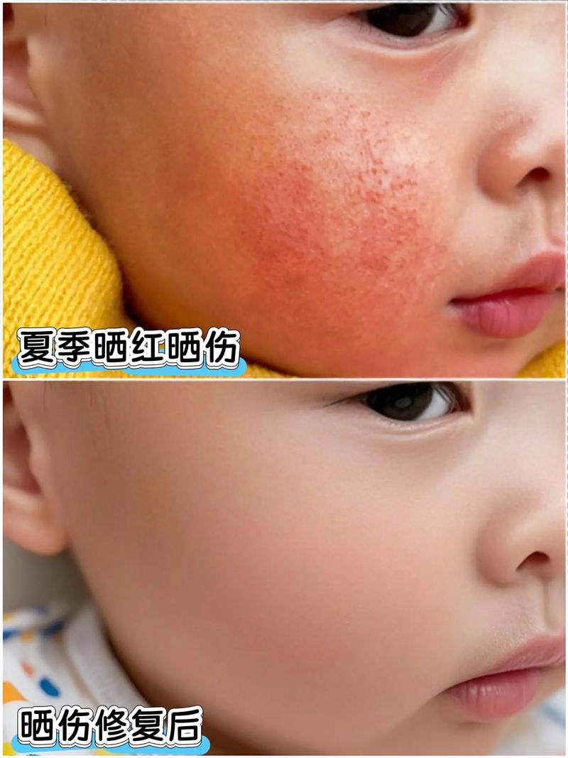 新生儿被太阳晒伤图片警示，家长该如何科学防晒避免悲剧？-第1张图片-郑州医学网