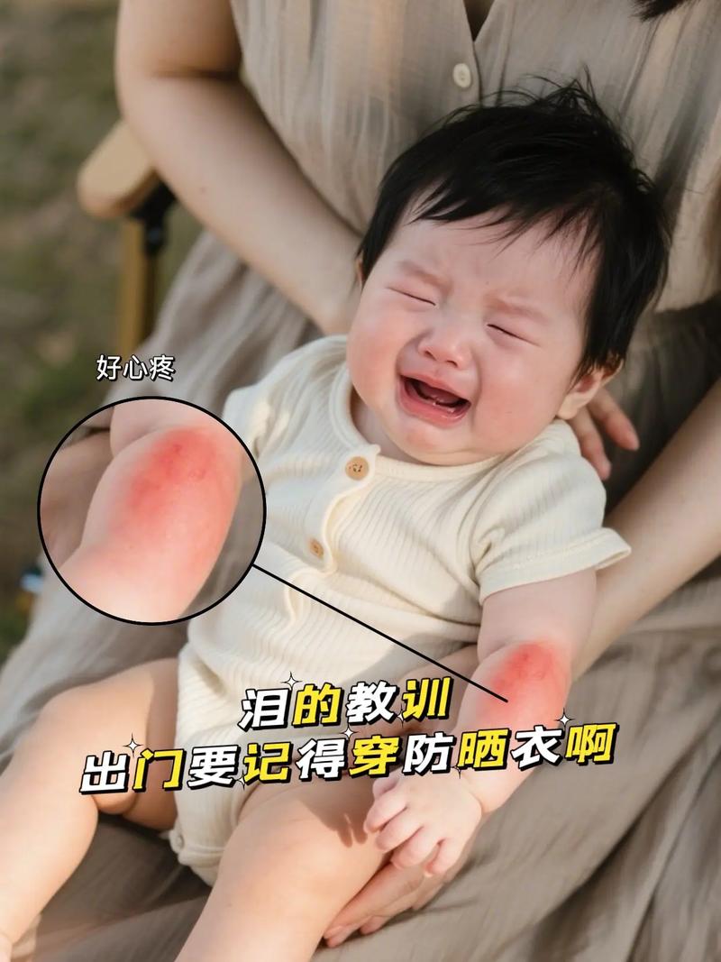 新生儿被太阳晒伤图片警示，家长该如何科学防晒避免悲剧？-第2张图片-郑州医学网