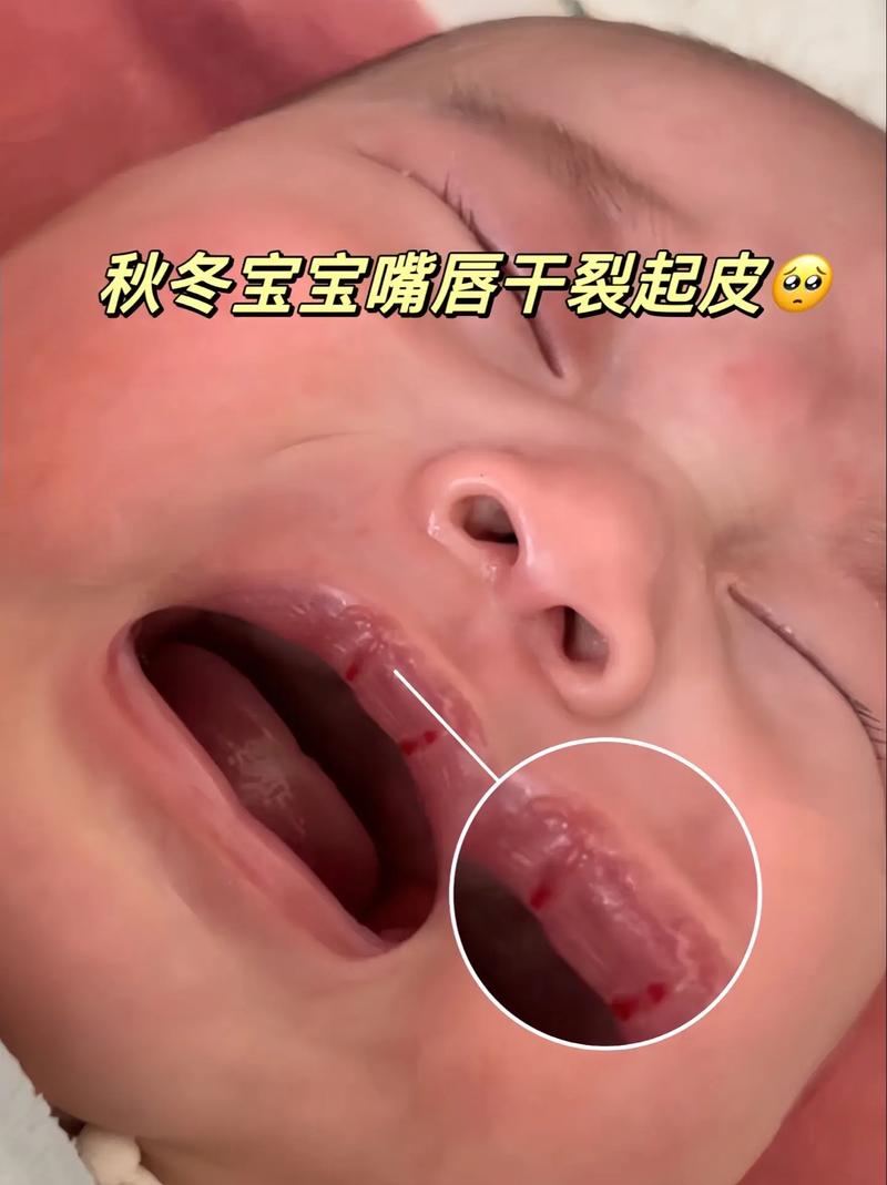 新生儿喝母乳嘴唇干是缺水还是其他原因?如何正确护理?-第1张图片-郑州医学网 新生儿喝母乳嘴唇干是缺水还是其他原因?如何正确护理?-第1张图片-郑州医学网