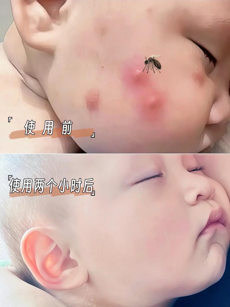 新生儿身上是否有特殊气味或生理机制让蚊子避而远之？-第1张图片-郑州医学网