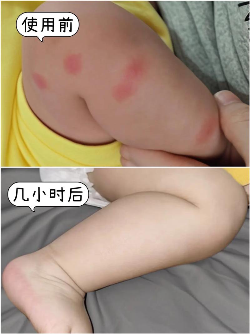 新生儿身上是否有特殊气味或生理机制让蚊子避而远之？-第3张图片-郑州医学网