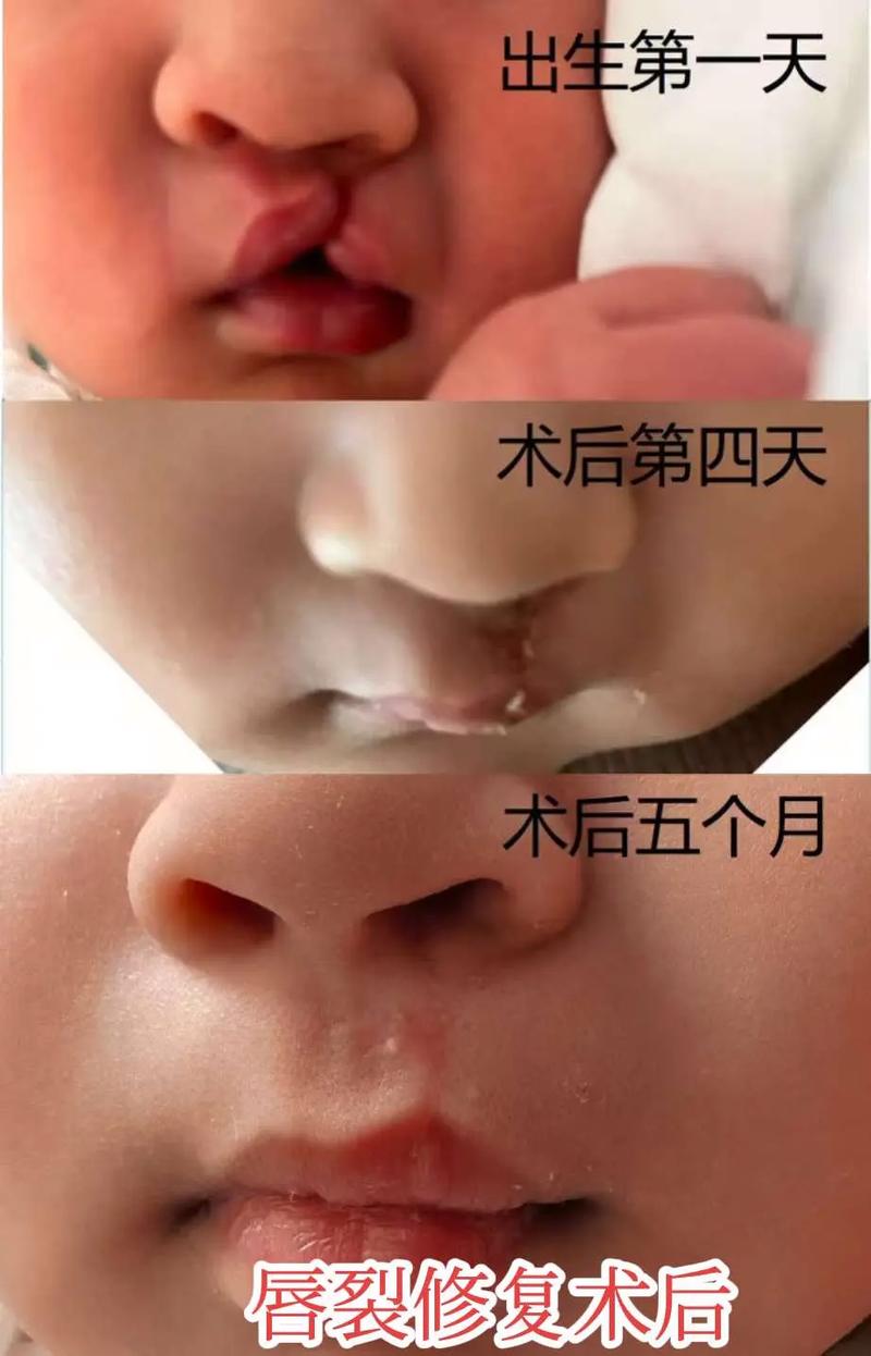 新生儿兔唇手术费用受哪些因素影响？医保能报销多少？-第1张图片-郑州医学网