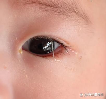新生儿眼屎多、流泪不止，是上火还是眼睛出问题了？-第1张图片-郑州医学网