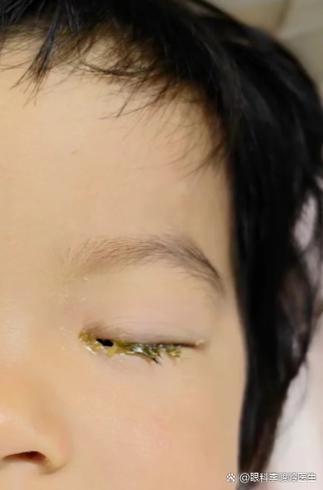 新生儿眼屎多、流泪不止，是上火还是眼睛出问题了？-第2张图片-郑州医学网