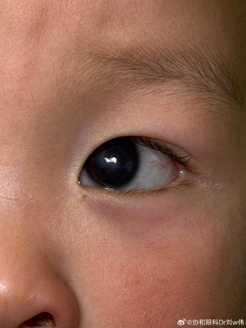 新生儿眼周围小白点是什么原因？需要治疗吗？会对视力有影响吗？-第1张图片-郑州医学网