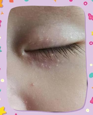 新生儿眼周围小白点是什么原因？需要治疗吗？会对视力有影响吗？-第2张图片-郑州医学网