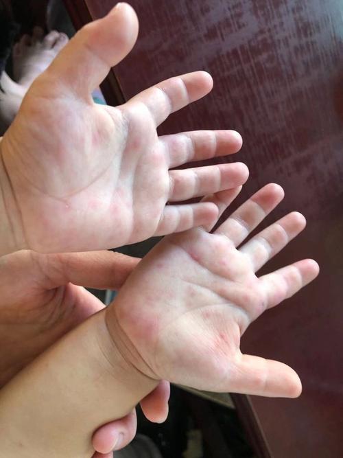 新生儿手足徐动症有哪些具体表现？家长该如何早期识别与应对？-第1张图片-郑州医学网