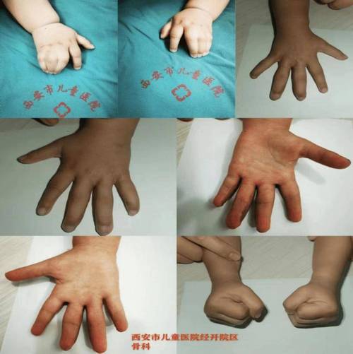 新生儿手足徐动症有哪些具体表现？家长该如何早期识别与应对？-第2张图片-郑州医学网