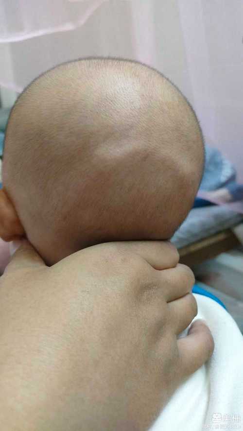 新生儿后脑勺突出是正常现象吗?附图片解析需注意哪些问题?-第2张图片-郑州医学网 新生儿后脑勺突出是正常现象吗?附图片解析需注意哪些问题?-第2张图片-郑州医学网
