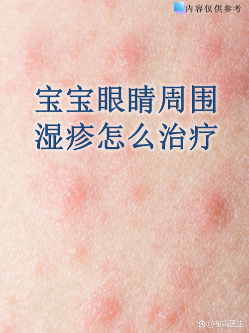 儿童过敏该选哪家医院？专业科室、专家团队与治疗经验如何权衡？-第1张图片-郑州医学网