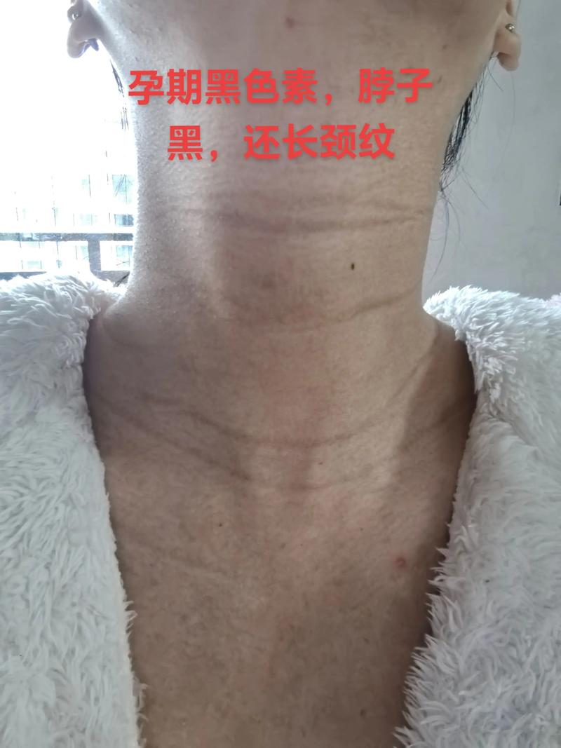 孕期脖子腋下变黑生男-第1张图片-郑州医学网