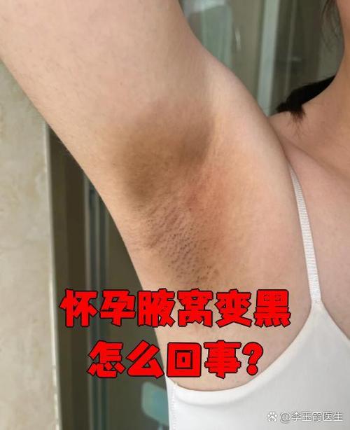 孕期脖子腋下变黑生男-第2张图片-郑州医学网