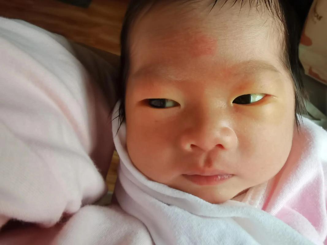 新生儿眼睛眼白发黄是正常现象还是健康预警？需警惕哪些潜在问题？-第1张图片-郑州医学网