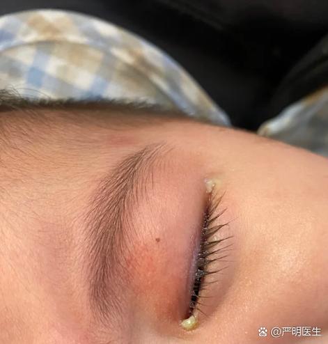 新生儿眼睛眼白发黄是正常现象还是健康预警？需警惕哪些潜在问题？-第2张图片-郑州医学网