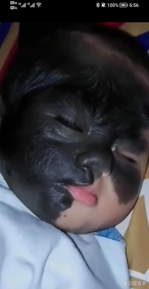 新生儿脸上有黑色胎记-第1张图片-郑州医学网