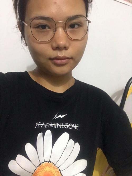 新生儿脸上有黑色胎记-第2张图片-郑州医学网