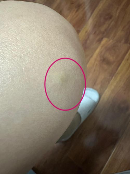 新生儿大腿摸到硬块是正常现象还是疾病信号？需要警惕哪些潜在问题？-第2张图片-郑州医学网