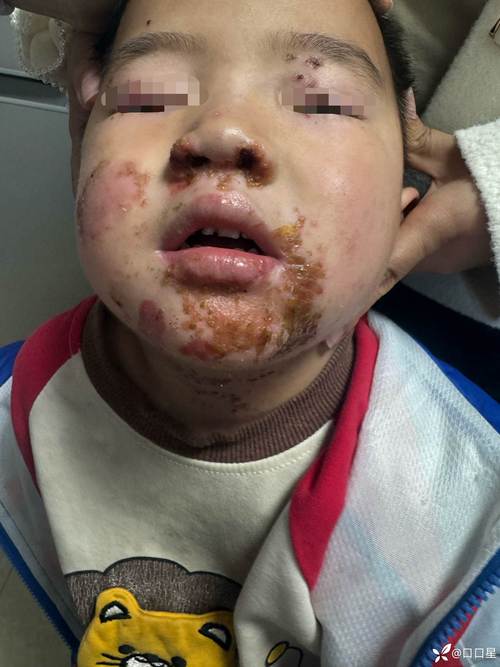 儿童烟雾病早期症状有哪些容易被忽视的信号?家长该如何识别?-第3张图片-郑州医学网 儿童烟雾病早期症状有哪些容易被忽视的信号?家长该如何识别?-第3张图片-郑州医学网