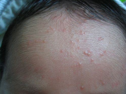 儿童额头长小疙瘩是什么原因?需要警惕哪些疾病?-第2张图片-郑州医学网 儿童额头长小疙瘩是什么原因?需要警惕哪些疾病?-第2张图片-郑州医学网