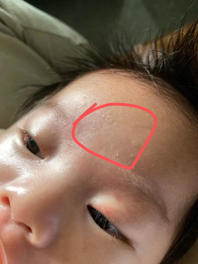 儿童额头长小疙瘩是什么原因?需要警惕哪些疾病?-第1张图片-郑州医学网 儿童额头长小疙瘩是什么原因?需要警惕哪些疾病?-第1张图片-郑州医学网