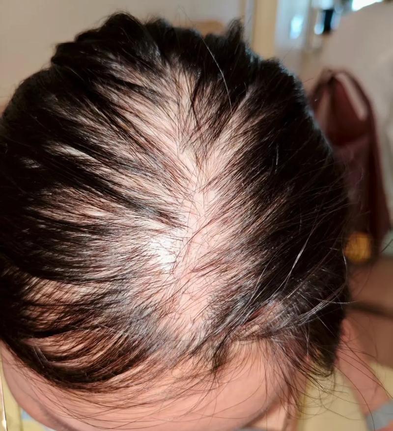 孕期斑秃的幕后推手有哪些？激素波动还是营养缺口在作祟？-第1张图片-郑州医学网