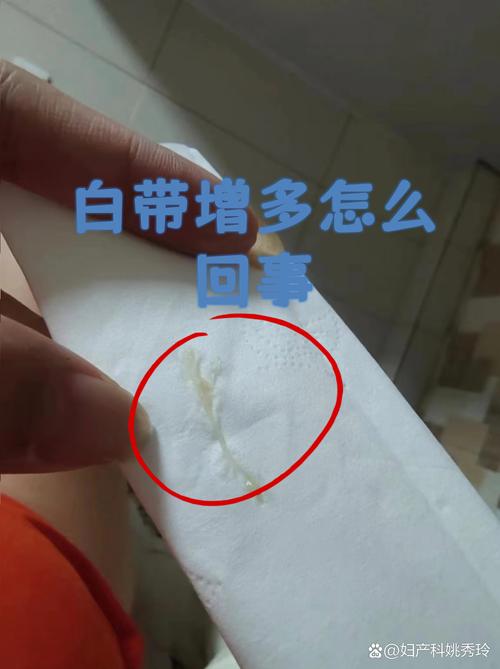 孕期白带拉丝是正常生理反应还是异常信号?需警惕哪些潜在风险?-第1张图片-郑州医学网 孕期白带拉丝是正常生理反应还是异常信号?需警惕哪些潜在风险?-第1张图片-郑州医学网