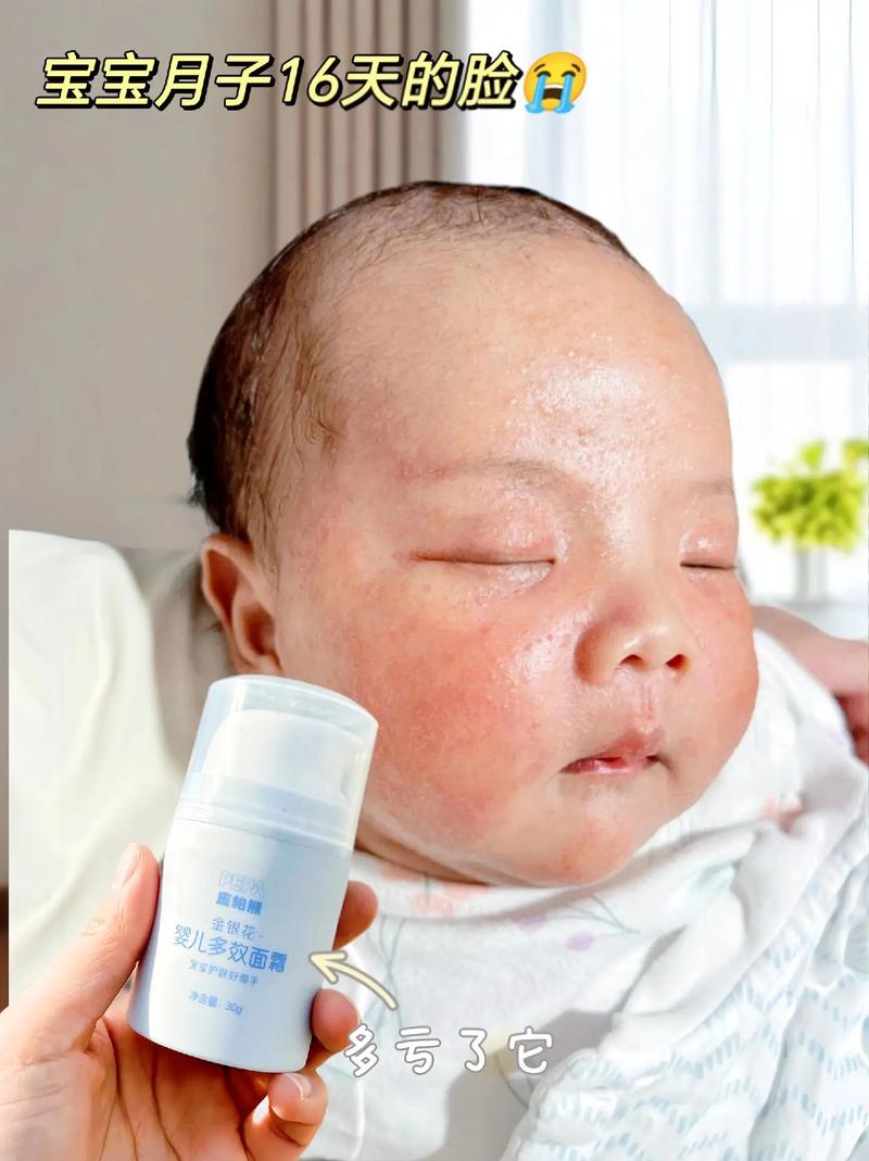 新生儿脸上红点点图片是湿疹还是痤疮?该如何正确处理和护理?-第2张图片-郑州医学网 新生儿脸上红点点图片是湿疹还是痤疮?该如何正确处理和护理?-第2张图片-郑州医学网