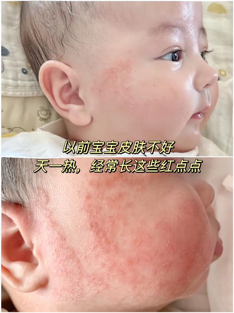 新生儿脸上红点点图片是湿疹还是痤疮?该如何正确处理和护理?-第3张图片-郑州医学网 新生儿脸上红点点图片是湿疹还是痤疮?该如何正确处理和护理?-第3张图片-郑州医学网