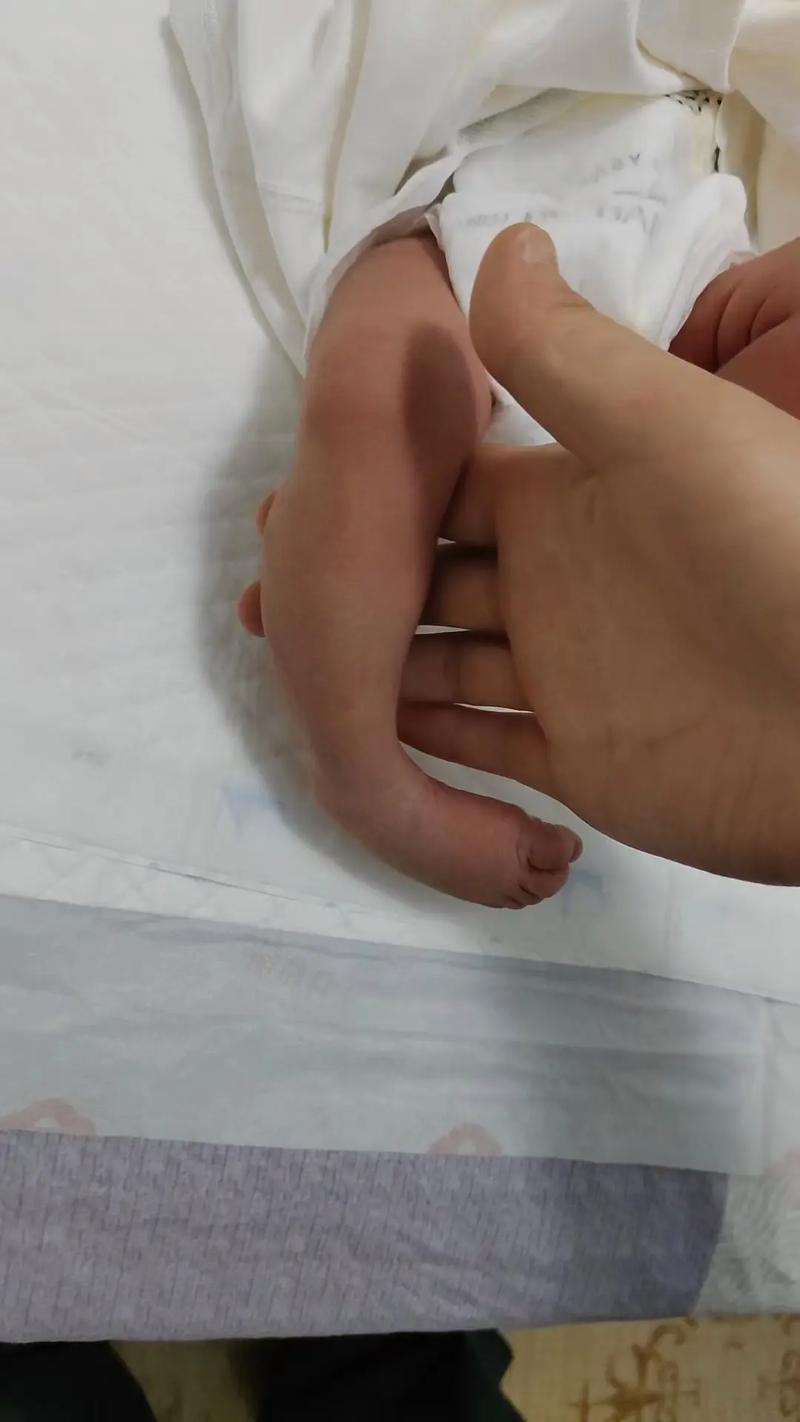 新生儿剪刀脚图片大全,剪刀脚是脑瘫信号吗?正常与异常区别在哪里?-第2张图片-郑州医学网 新生儿剪刀脚图片大全,剪刀脚是脑瘫信号吗?正常与异常区别在哪里?-第2张图片-郑州医学网
