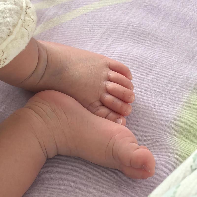 新生儿剪刀脚图片大全,剪刀脚是脑瘫信号吗?正常与异常区别在哪里?-第3张图片-郑州医学网 新生儿剪刀脚图片大全,剪刀脚是脑瘫信号吗?正常与异常区别在哪里?-第3张图片-郑州医学网