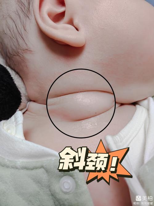 新生儿锁骨处骨头突出是正常生理现象还是骨骼发育异常？-第1张图片-郑州医学网
