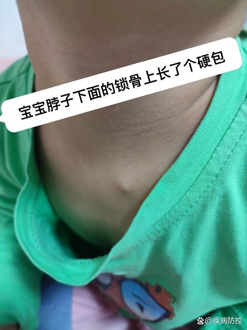 新生儿锁骨处骨头突出是正常生理现象还是骨骼发育异常？-第2张图片-郑州医学网