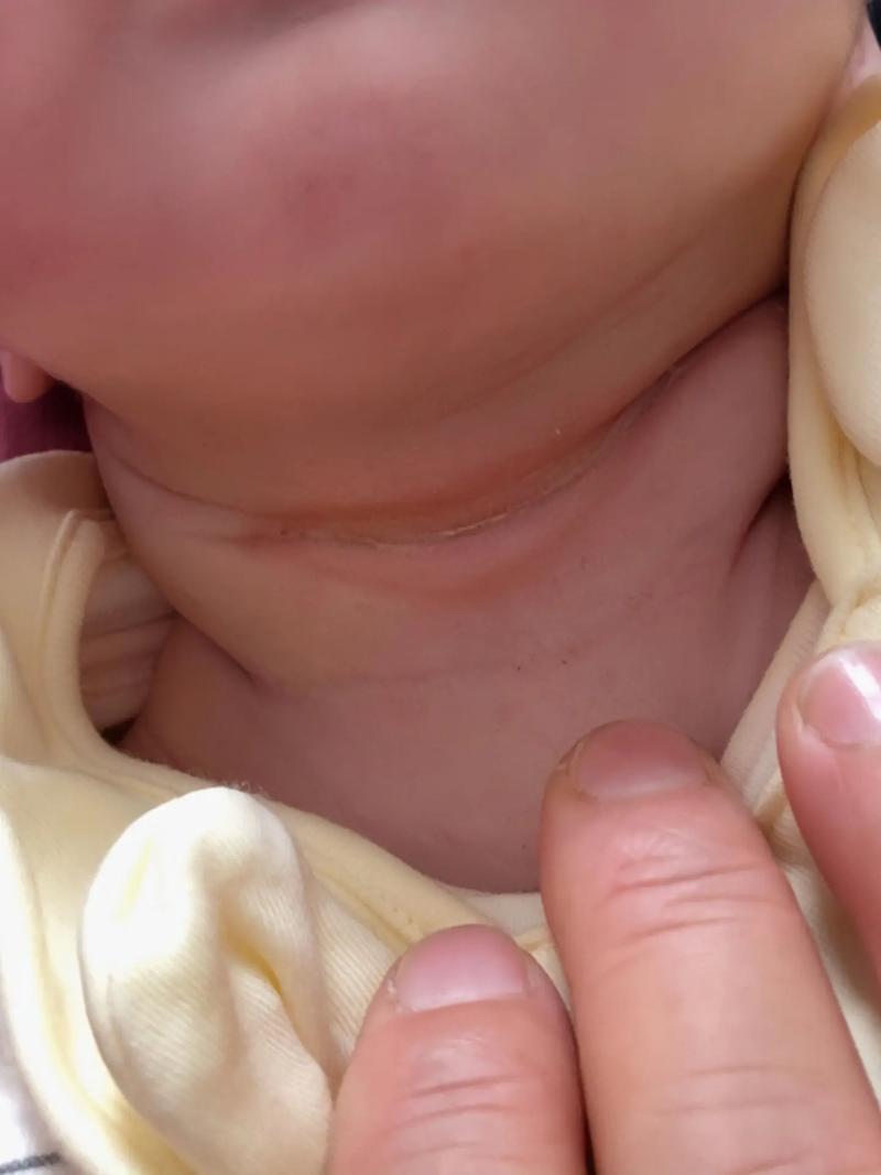 新生儿脖子褶皱处破皮-第1张图片-郑州医学网 新生儿脖子褶皱处破皮-第1张图片-郑州医学网