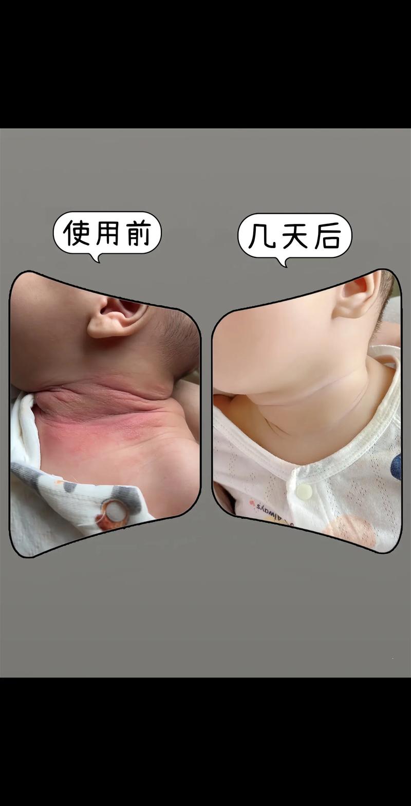 新生儿脖子褶皱处破皮-第2张图片-郑州医学网 新生儿脖子褶皱处破皮-第2张图片-郑州医学网