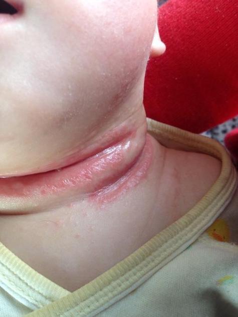 新生儿脖子褶皱处破皮-第3张图片-郑州医学网 新生儿脖子褶皱处破皮-第3张图片-郑州医学网