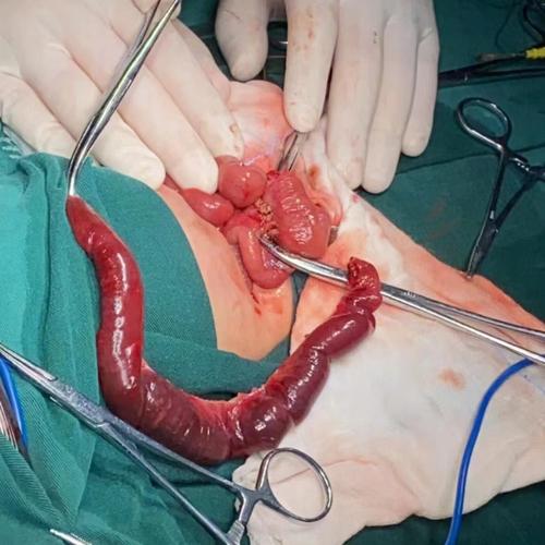 新生儿肠重复畸形手术的时机、风险及术后护理该注意什么?-第1张图片-郑州医学网 新生儿肠重复畸形手术的时机、风险及术后护理该注意什么?-第1张图片-郑州医学网