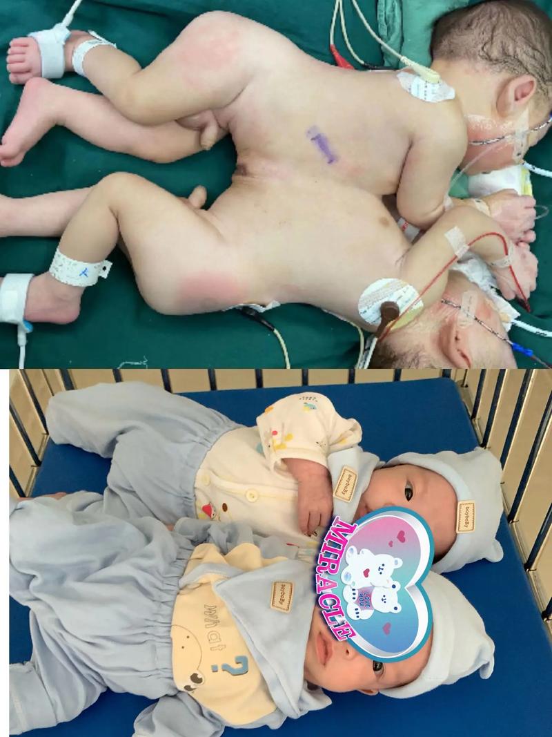 新生儿肠重复畸形手术的时机、风险及术后护理该注意什么？-第3张图片-郑州医学网