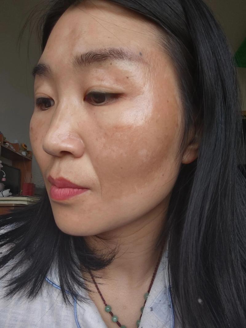 孕期长蝴蝶斑真能预示生女儿吗?科学依据是什么?-第1张图片-郑州医学网 孕期长蝴蝶斑真能预示生女儿吗?科学依据是什么?-第1张图片-郑州医学网