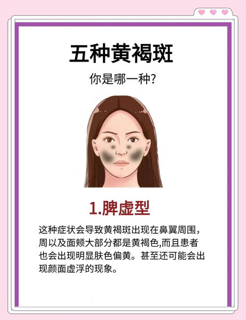孕期长蝴蝶斑真能预示生女儿吗？科学依据是什么？-第3张图片-郑州医学网