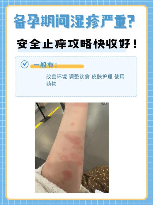 备孕期间突发湿疹，用药怕影响胎儿，该如何安全应对？-第3张图片-郑州医学网