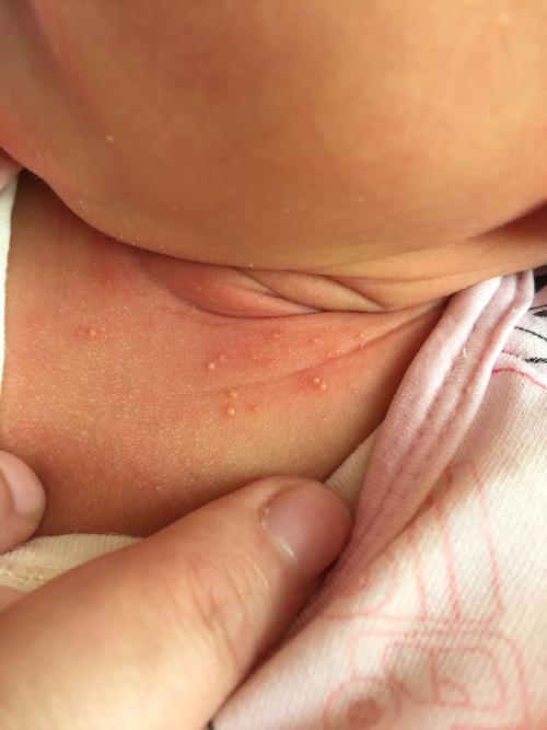 新生儿脖子白色分泌物是正常胎脂还是需警惕的皮肤病？-第1张图片-郑州医学网