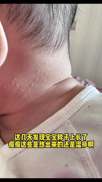 新生儿脖子白色分泌物是正常胎脂还是需警惕的皮肤病？-第3张图片-郑州医学网