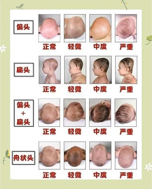 新生儿额头突出是正常发育现象还是需要警惕的异常情况?-第1张图片-郑州医学网 新生儿额头突出是正常发育现象还是需要警惕的异常情况?-第1张图片-郑州医学网