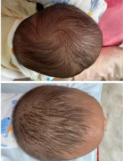 新生儿额头突出是正常发育现象还是需要警惕的异常情况?-第2张图片-郑州医学网 新生儿额头突出是正常发育现象还是需要警惕的异常情况?-第2张图片-郑州医学网