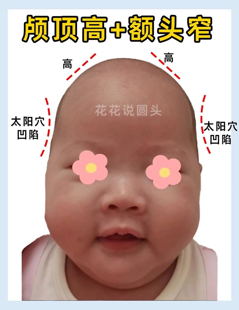 新生儿额头突出是正常发育现象还是需要警惕的异常情况?-第3张图片-郑州医学网 新生儿额头突出是正常发育现象还是需要警惕的异常情况?-第3张图片-郑州医学网